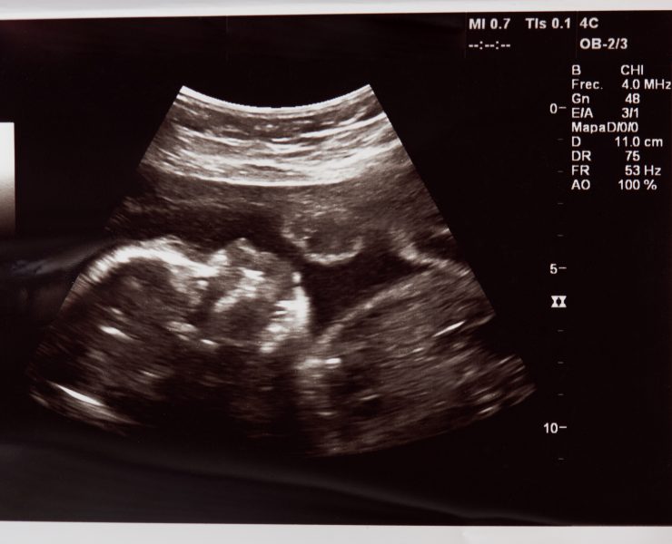 Healing After Pregnancy Loss, Raise Magazine